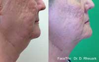 Facetite Before and After