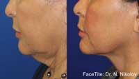 Facetite Before and After