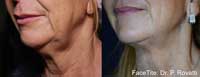 Facetite Before and After