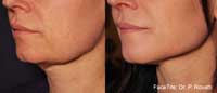 Facetite Before and After