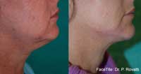 Facetite Before and After