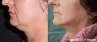 Facetite Before and After