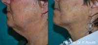 Facetite Before and After