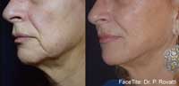 Facetite Before and After