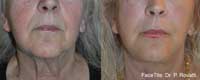 Facetite Before and After