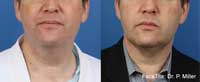 Facetite Before and After