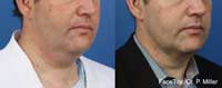 Facetite Before and After