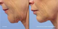 Facetite Before and After