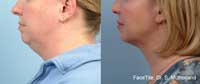 Facetite Before and After