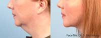 Facetite Before and After