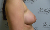Patient 1 implants only side after