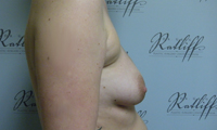 Patient 1 implants only side before