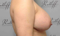 Patient 2 implants only side after