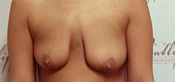 9 month scar recovery before