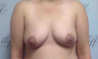 Patient 3 implants only front before