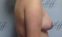 Patient 3 implants only side before