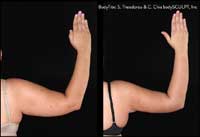 Arm tightening before and after