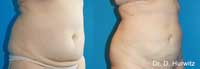 Abdomen Contraction before and after images